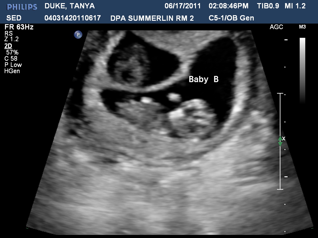 Week 10 Ultrasound - Duke Twins