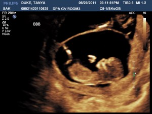 Duke Twins Week 12 Ultrasound Baby B