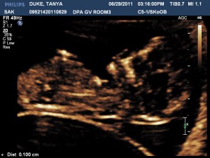 Duke Twins Week 12 Ultrasound Baby A
